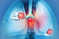 Giật mình dấu hiệu ở đầu cảnh báo ung thư phổi ít người biết