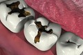 Top các bệnh răng miệng nguy hiểm dễ tấn công người già