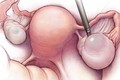 U xơ tử cung và cách điều trị hữu hiệu