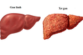 Gan lỗ chỗ như tổ ong vì rượu, bác sĩ rùng mình