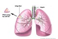 Dấu hiệu bạn bị ung thư phổi