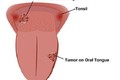 Các giai đoạn của ung thư lưỡi