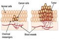 Bộ phận nào của cơ thể dễ bị di căn ung thư?