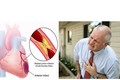 Làm thế nào để nhận biết cơn đau tim và đột quỵ?