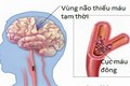 Kết hợp Đông, Tây y điều trị thiểu năng tuần hoàn não 