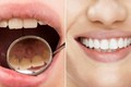 Loại bỏ cao răng hiệu quả với 5 mẹo đơn giản tại nhà