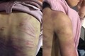 Hà Nội: Bé gái 12 tuổi nghi bị mẹ đẻ bạo hành, người tình của mẹ hãm hiếp