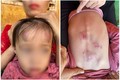 Bé gái 2 tuổi bị bạn học đánh, đạp dã man ở Bắc Giang
