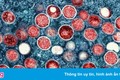 Người nhiễm virus Mpox gây bệnh đậu mùa khỉ nên đi xét nghiệm HIV