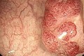 Polyp đường ruột có phát triển thành ung thư ruột kết?