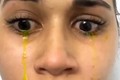 Cô gái hốt hoảng khi khóc ra nước mắt màu vàng 