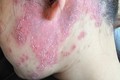 Nữ bệnh nhân tổn thương đa cơ quan vì Lupus ban đỏ