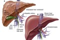 Tìm hiểu về ung thư gan nguyên phát đa ổ