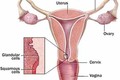 Cách ngừa ung thư cổ tử cung bằng tiêm chủng