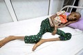 Những bức hình ám ảnh về tình trạng suy sinh dưỡng ở Yemen
