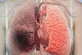 Mai Phương bị ung thư phổi: Ngừa bệnh thế nào?