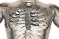 Bệnh nhân ung thư được ghép xương bằng máy in 3D