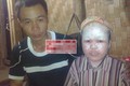 Cậu bé “người cá” suýt bị chôn sống ở Hà Giang
