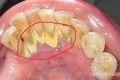 Mách bạn '5 mẹo' dễ dàng để loại bỏ cao răng tại nhà