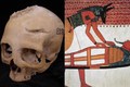 4.000 năm trước Ai Cập đã phẫu thuật điều trị ung thư não? 