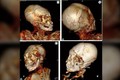 Phát hiện chấn thương trên xác ướp Nam Mỹ 1.000 năm tuổi