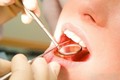 Cách làm bong mảng bám răng, vôi răng từ vỏ chanh, giấm