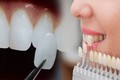 Tác hại đáng sợ của việc mài răng trước khi bọc răng sứ