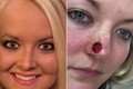 Thiếu nữ bị biến dạng khuôn mặt khủng khiếp do ung thư da