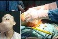 Phẫu thuật thành công khối u khổng lồ trên mặt cụ ông