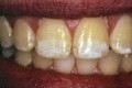 Người cao tuổi và các bệnh răng miệng thường gặp