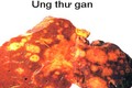 Thêm dấu hiệu đáng ngờ của ung thư gan