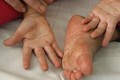 Bệnh tay chân miệng: Chủng virus EV 71 có thể gây chết người