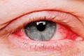 Làm gì khi đi chơi Tết bất ngờ bị đau mắt đỏ? 