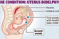 Tiết lộ về chuyện khó nói của người có tử cung kép