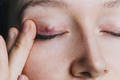 5 nguyên nhân gây ra tình trạng nổi u trên mí mắt