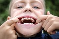 Cậu bé có hai hàng răng như cá mập