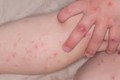 Hà Nội ghi nhận 290 ca bệnh tay chân miệng trong tuần 