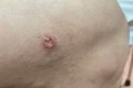 Phát hiện thêm ca bệnh giun rồng thứ 26 tại Phú Thọ