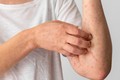 Nhiều bệnh da liễu phát triển trong mùa hè