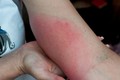 Bị ong đốt hơn 150 vết, người đàn ông nguy kịch tính mạng