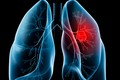 Ung thư phổi ở đàn ông và đàn bà khác nhau thế nào?