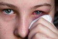 Hiểu bệnh đau mắt đỏ để dập dịch