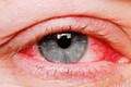 Hải Phòng: Bệnh đau mắt đỏ có nguy cơ bùng phát