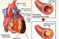 Rối loạn mỡ máu và nguy cơ các bệnh tim mạch