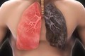 Những quan niệm sai lầm thường gặp về ung thư phổi