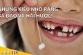 Video: Muôn kiểu nhổ răng bá đạo cho trẻ nhỏ