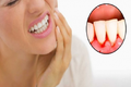 Dấu hiệu của răng miệng báo động tim, gan, thận không khỏe