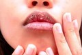 Những dấu hiệu ở miệng giúp "tiên đoán" ung thư gan