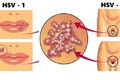 5 điều nên biết khi bị mụn rộp sinh dục