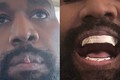 Gương mặt Kanye West biến dạng sau khi nhổ hết răng
